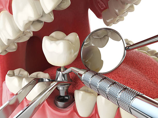 Best Emergency Root Canal Treatment in , KS